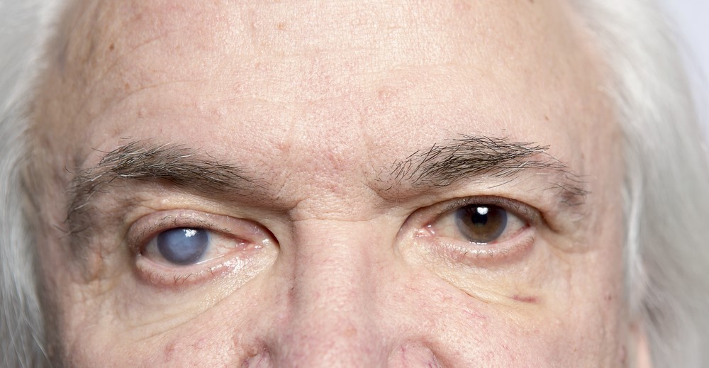 Glaucoma: doença silenciosa e principal causa de cegueira irreversível no mundo